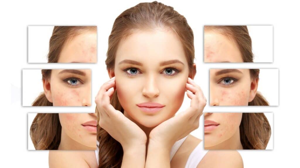 PRP Treatment for Acne Scars PRP Microneedling Los Angeles