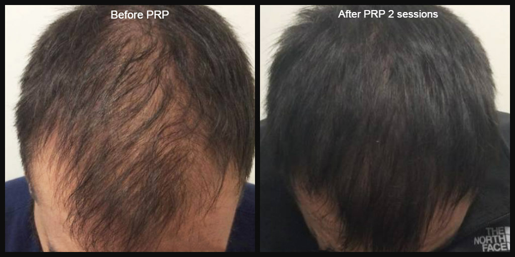 PRP Before and After