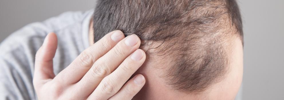 PRP Injections for Hair Loss - PRP Therapy Beverly Hills