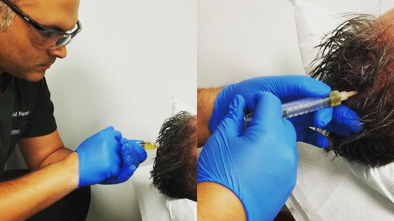 Why trust PRP Treatment Beverly Hills for your hair loss treatment