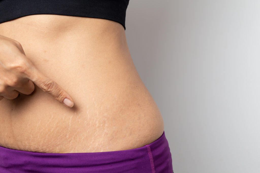PRP Treatment for Stretchmarks