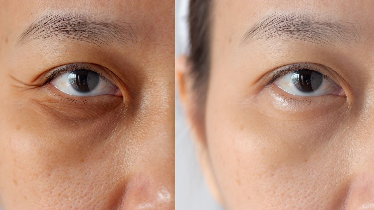Other causes for dark circles under the eyes