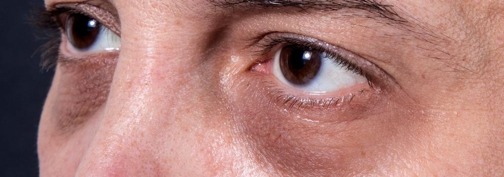 PRP Treatment to Eliminate dark circles under your eyes