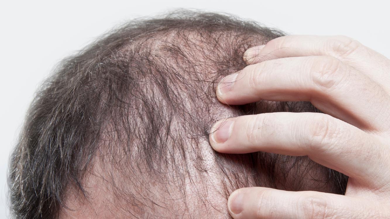 PRP For Hair Loss Procedure