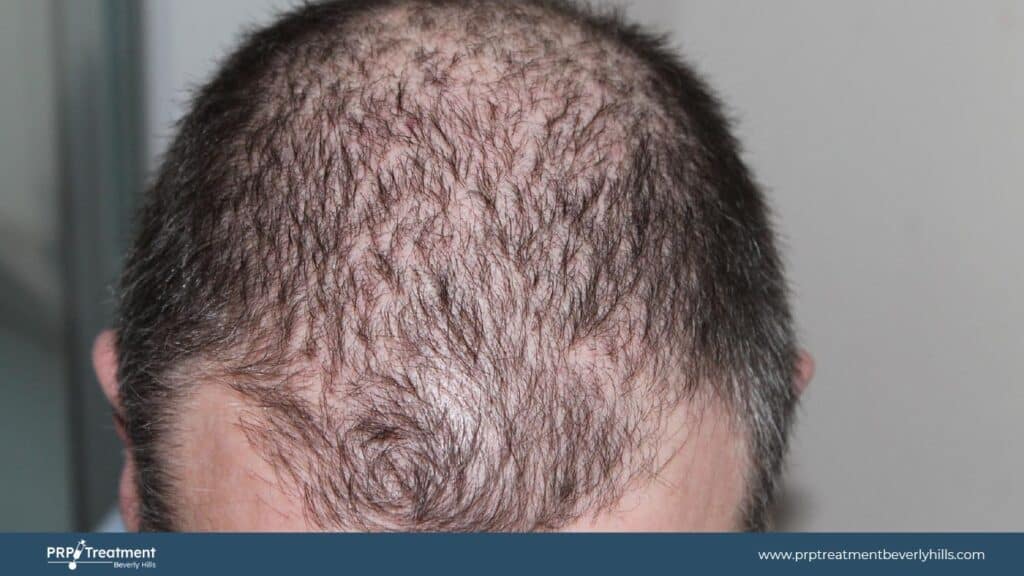 PRP For Hair Loss Near Me