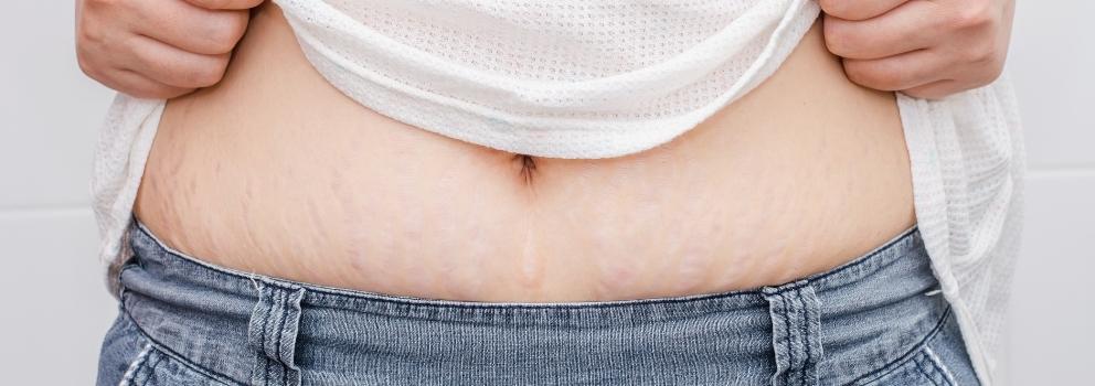 PRP Treatment for Stretch Mark