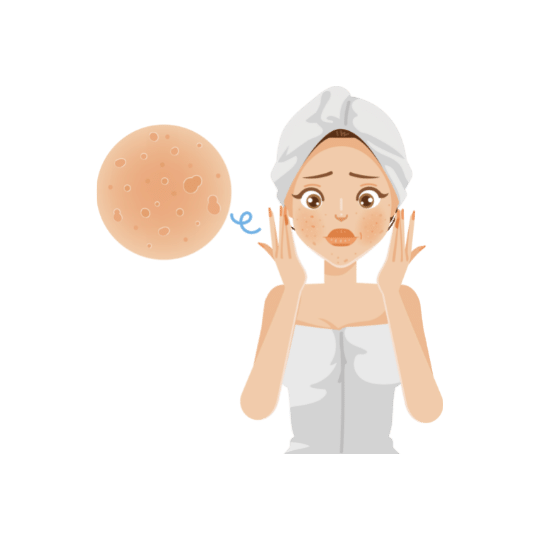 PRP Treatment for Acne Scars