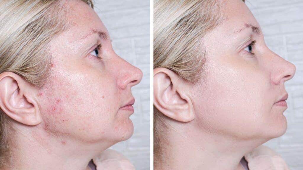 PRP With Derma Roller For Acne Scars - PRP Development