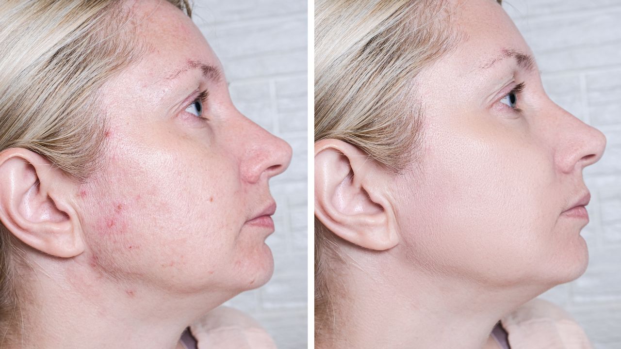 How long does the effectiveness of PRP with derma roller for acne scars last
