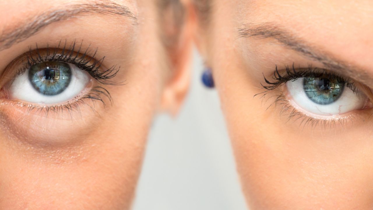 PRP Injections Under Eyes Side Effects