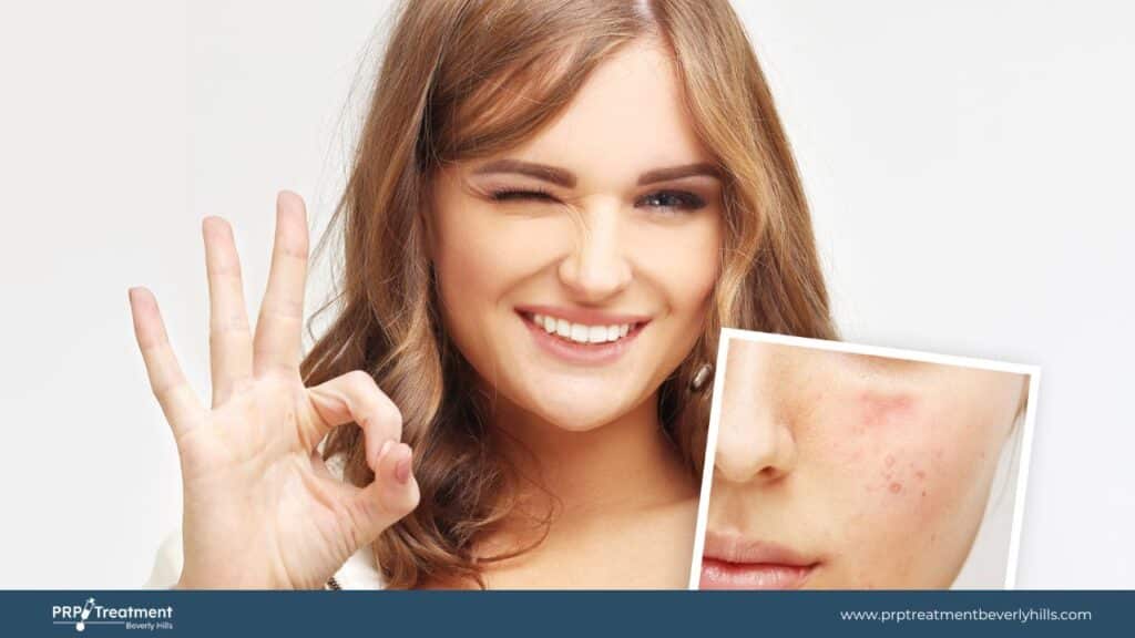 PRP With Derma Roller For Acne Scars PRP Development