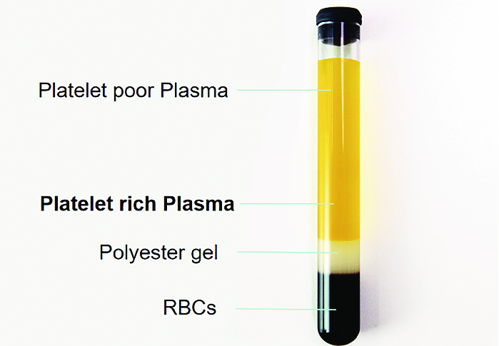 PRP tubes used in the treatment of PRP hair growth