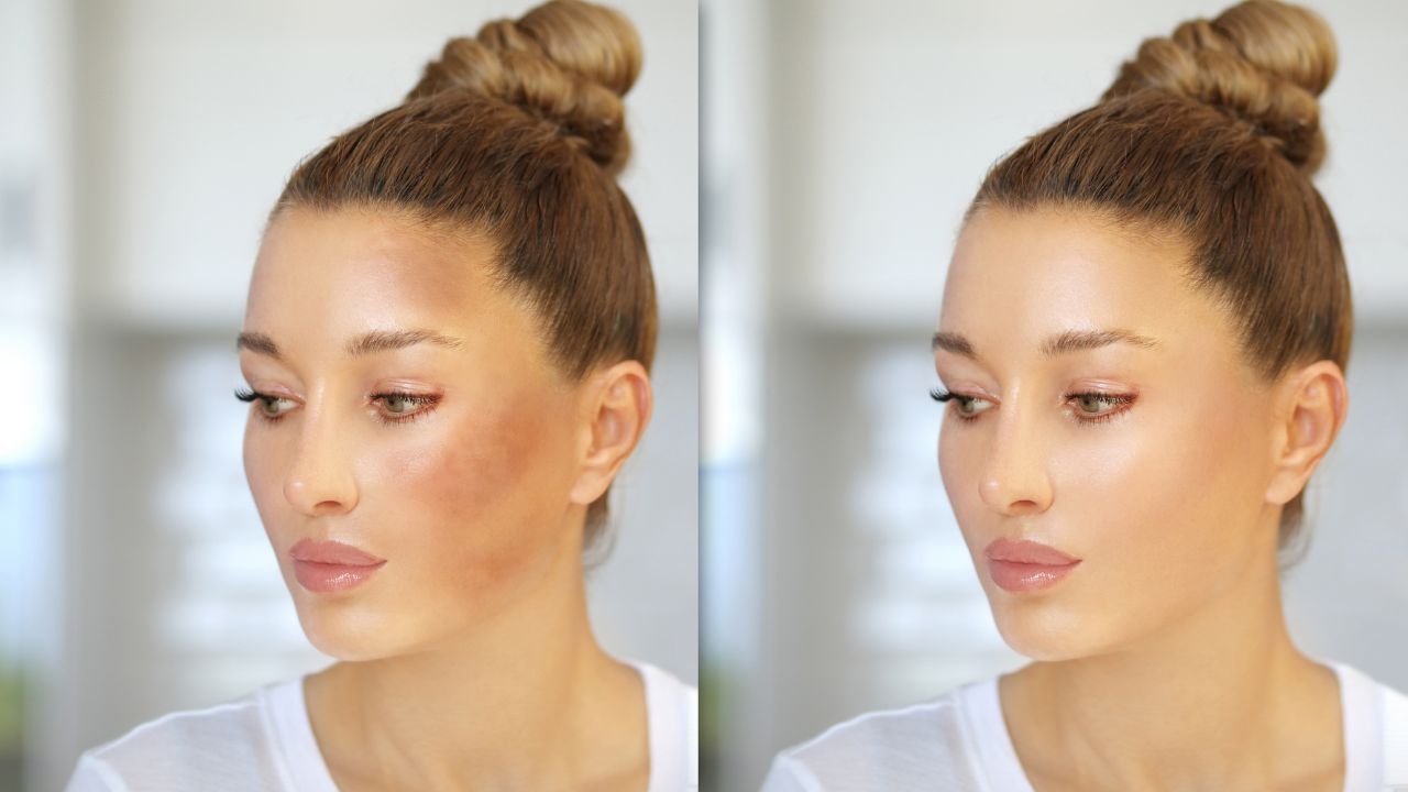 What happens before and after PRP microneedling for hyperpigmentation