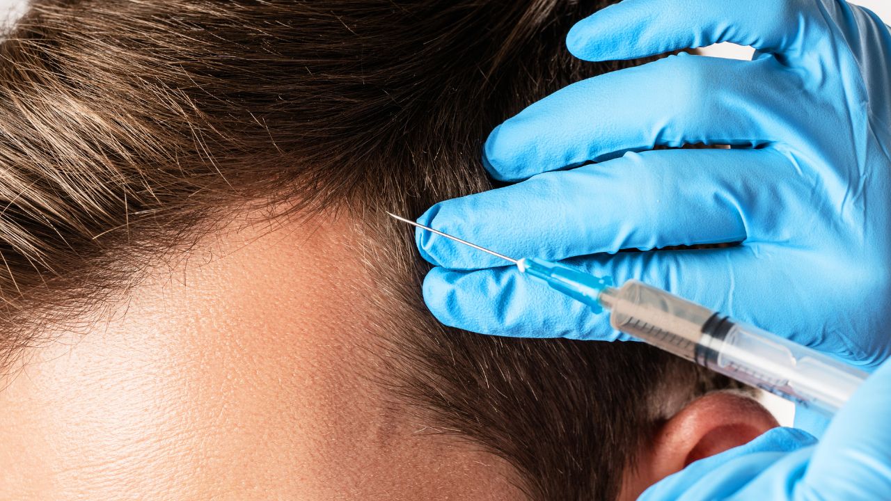 Does Hair Regrow After PRP Treatment
