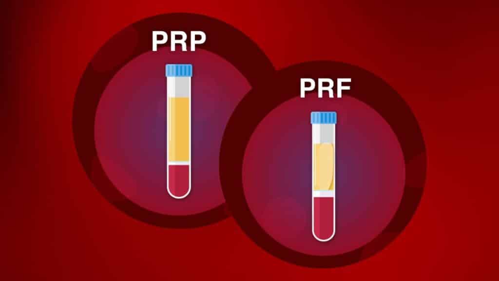PRP Vs PRF PRP Treatment