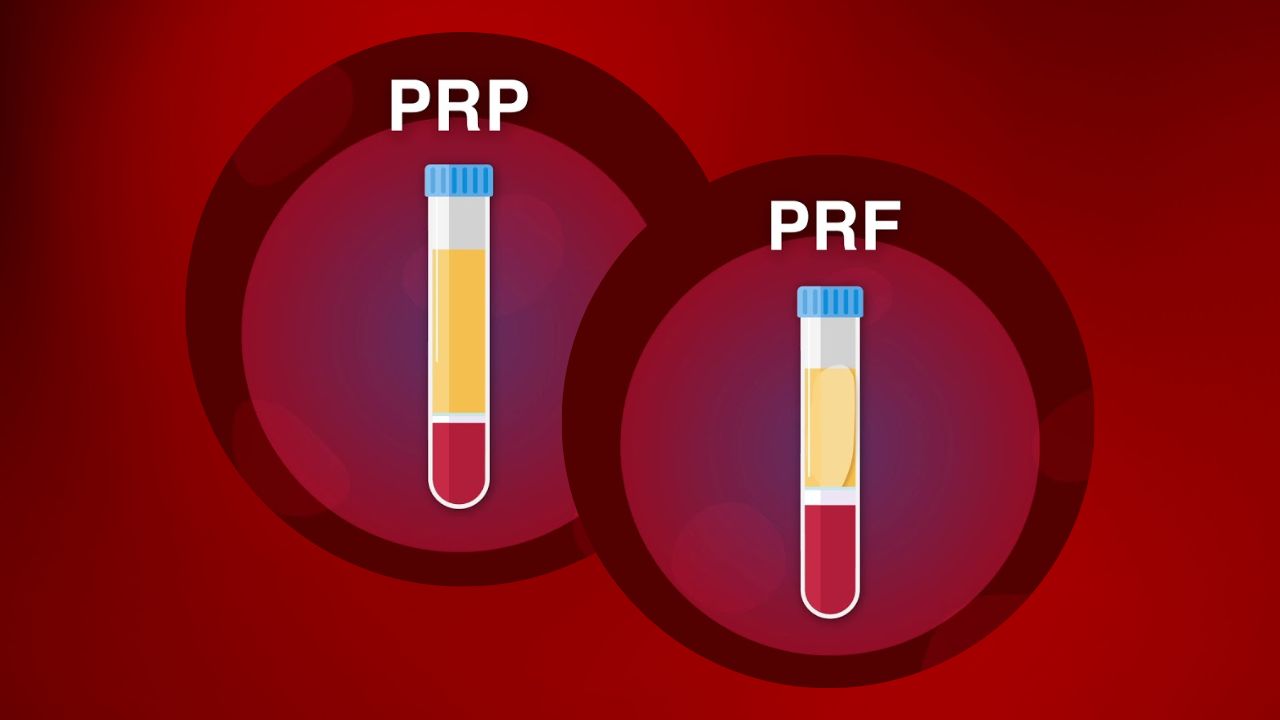PRP Vs PRF - PRP Treatment