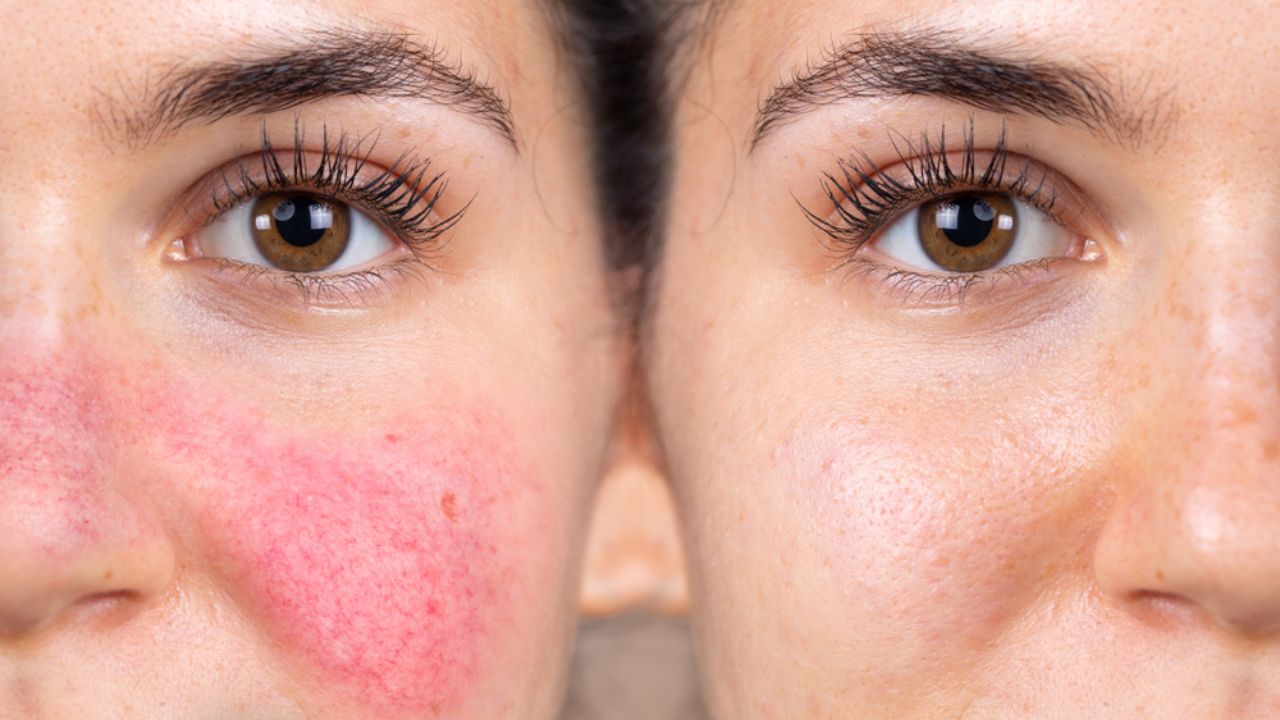 Rosacea and Redness - PRP Treatment
