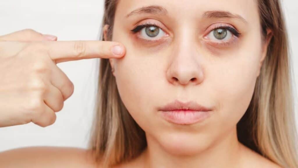 The Science Behind PRP for Dark Circles How Does it Work? PRP Treatment