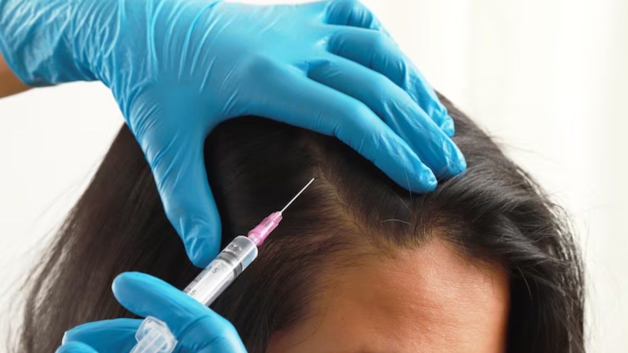 3 Month PRP For Hair Loss Before And After - The Impact of PRP on Hair Loss - PRP Treatment