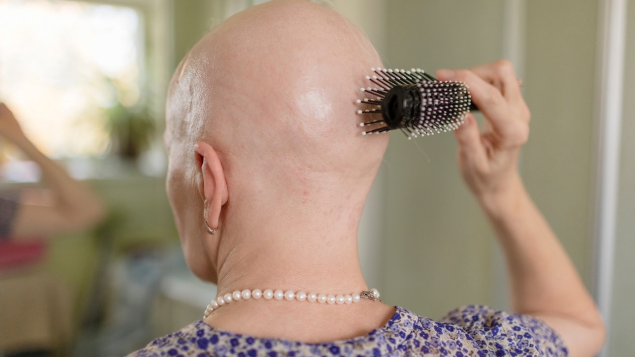 Androgenetic Alopecia in Women - PRP Therapy for Female Hair Loss Explained - PRP Treatment