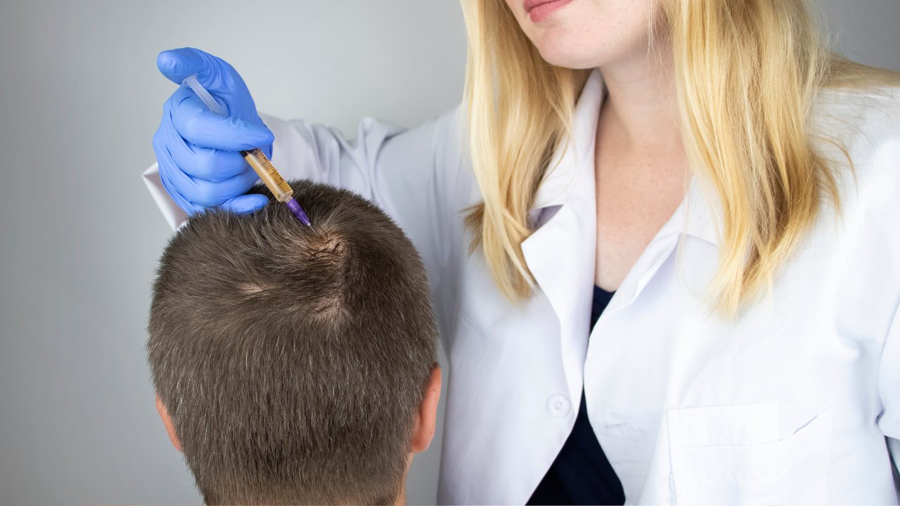 Unveiling the Best Treatments for Alopecia - PRP Treatment