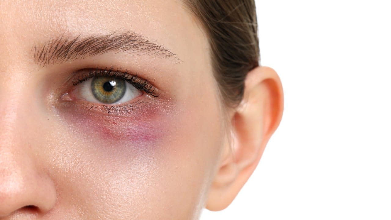 Is there any downtime or side effects associated with PRP under-eye treatments - PRP Treatment