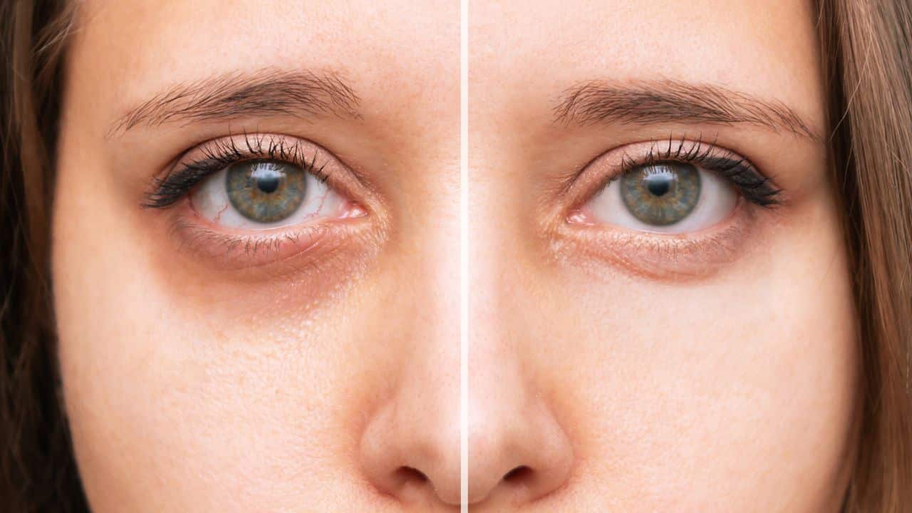 PRF Under Eyes How Long Does It Last - PRP Treatment