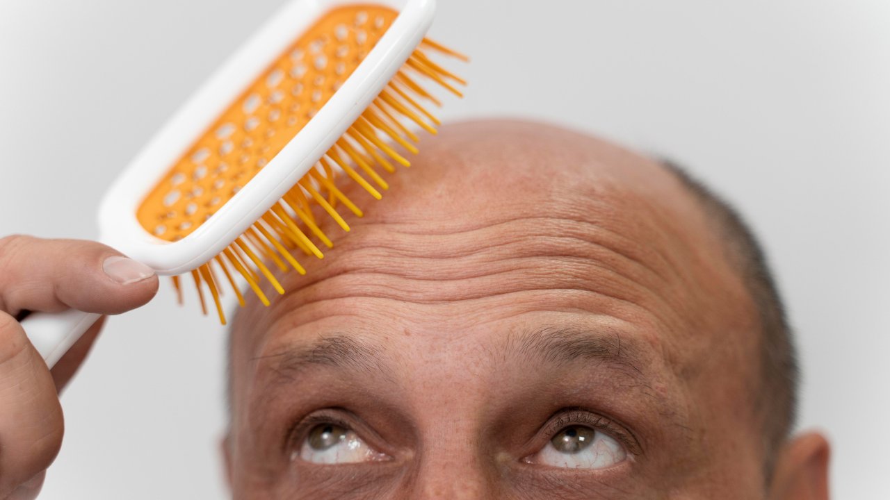 Can PRP Regrow Hair on a Bald Head - PRP Treatment
