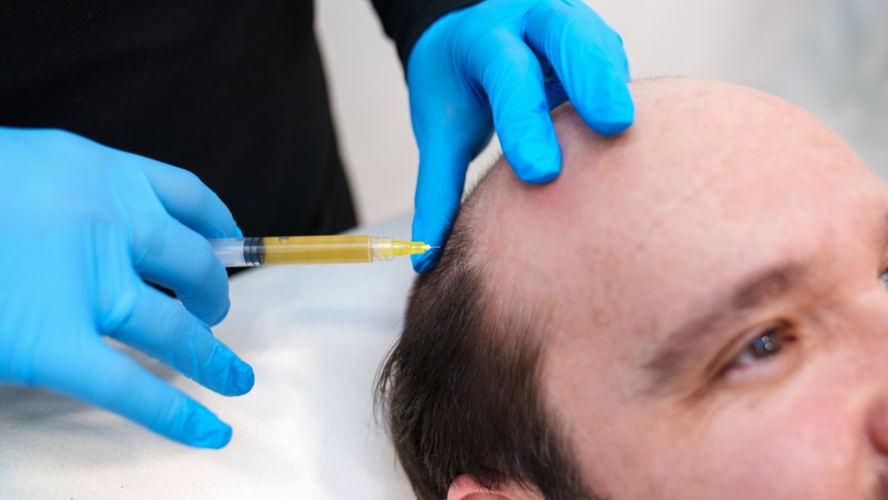 Can You Take PRP for Lifetime Hair Loss Management - PRP Treatment