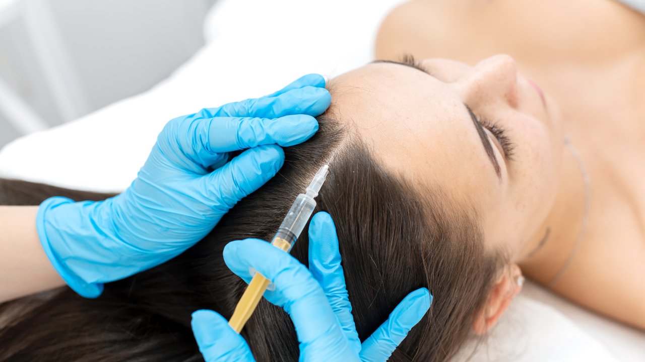 PRP for Hair Restoration