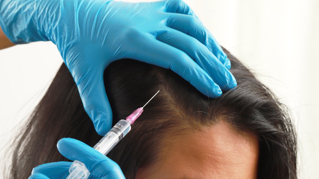 PRP for Hair Restoration